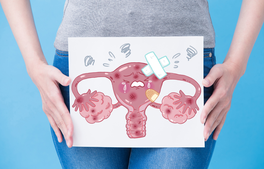 5 fatos sobre o câncer de ovário que toda mulher deve saber